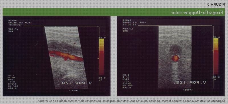 Las mejores marcas de venas doppler eco doppler de venas pierna izquierda