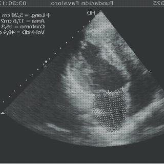 Las mejores doppler eco doppler elsevier