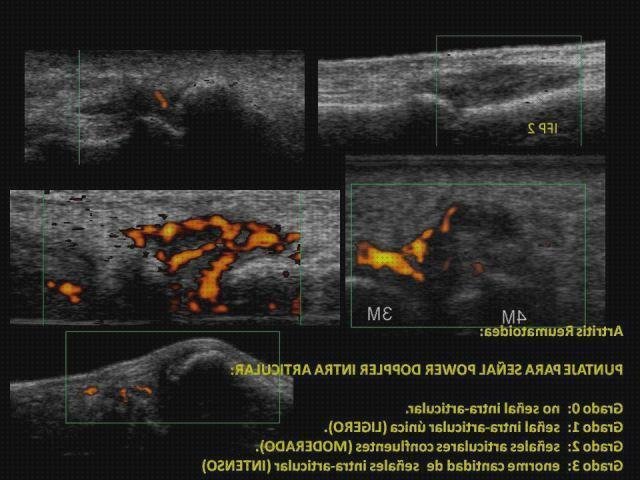 ¿Dónde poder comprar Mas explicación eco doppler medicina Mas eco doppler transtoracico ecografía doppler eco doppler en artritis?