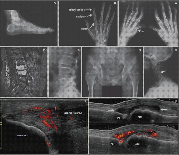 Review de eco doppler en artritis