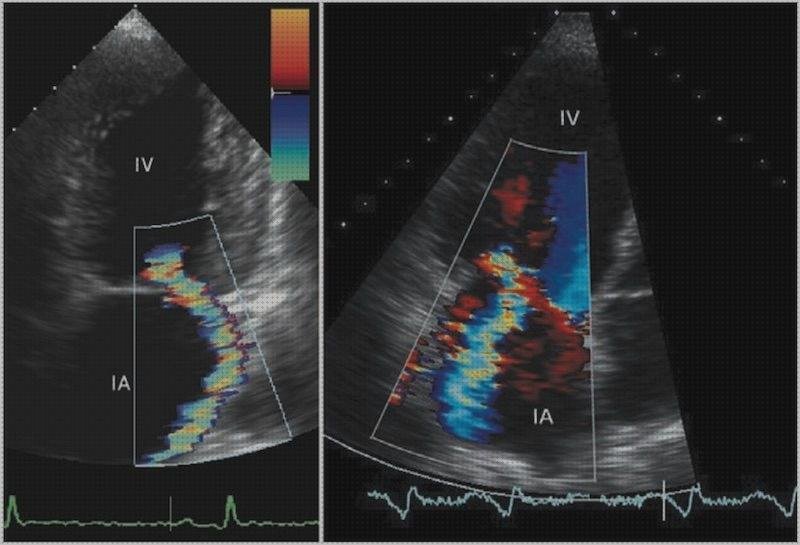 Análisis de los 4 mejores Ecos Doppler Estenosis Y Insuficiencias