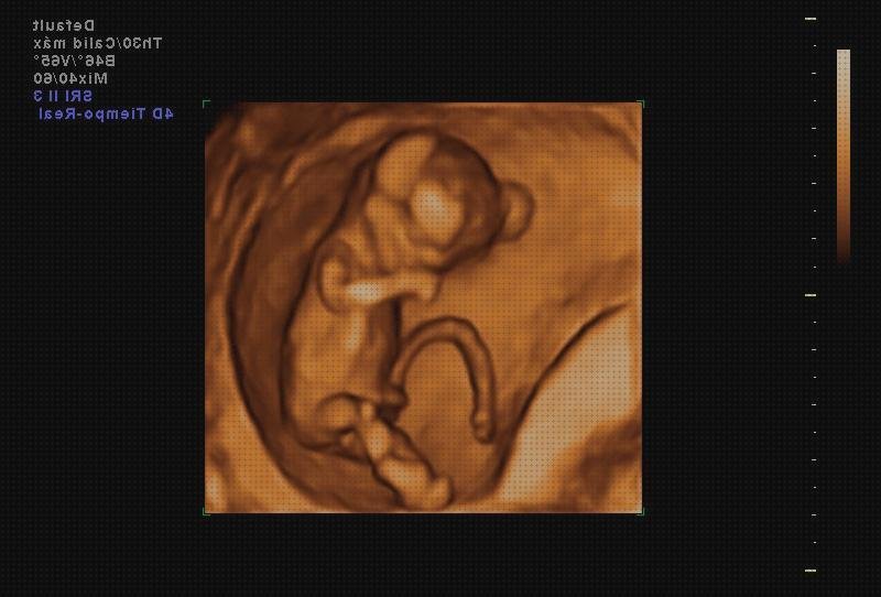 Las mejores marcas de ecografía 12 semanas doppler ecografía doppler eco doppler fetal 20 semanas