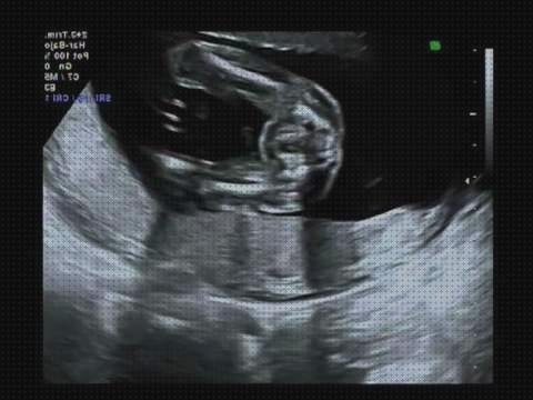 Review de eco doppler fetal 20 semanas