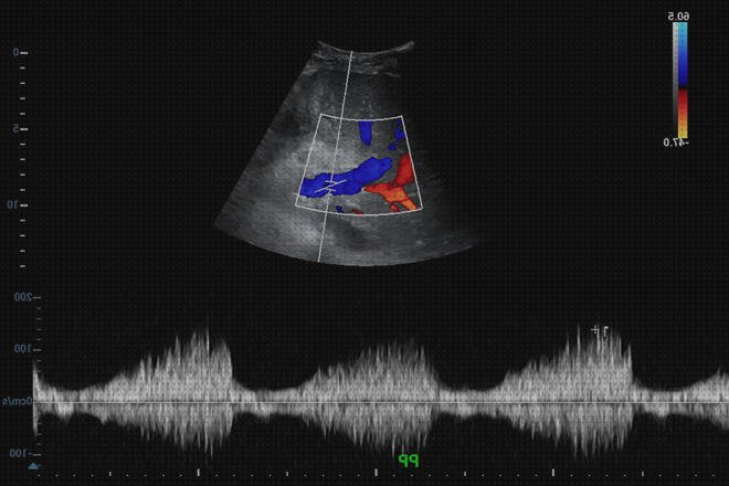 Las mejores higado doppler eco doppler higado