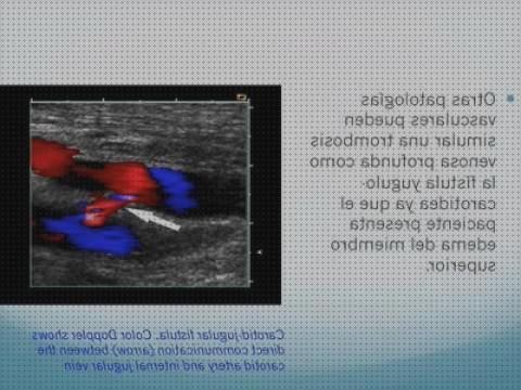 Opiniones de los 15 mejores Ecos Doppler Miembros Superiores