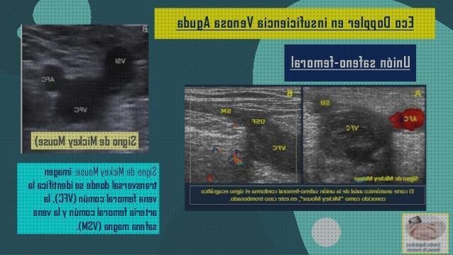 Las mejores ecos doppler eco doppler ojo