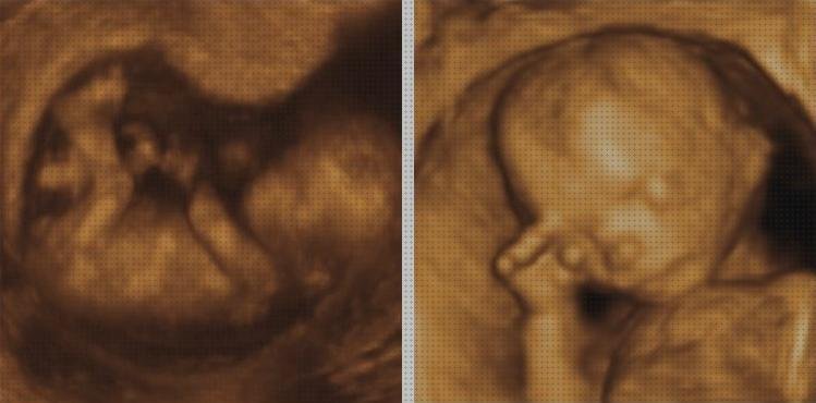 17 Mejores ecos doppler ojos