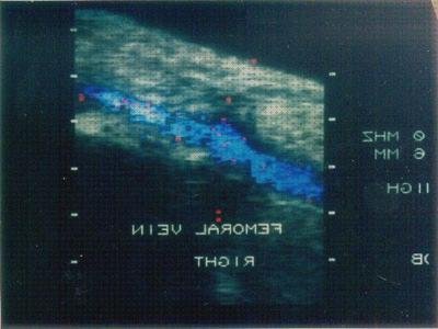 Las mejores marcas de pies ecos doppler eco doppler pie diabetico