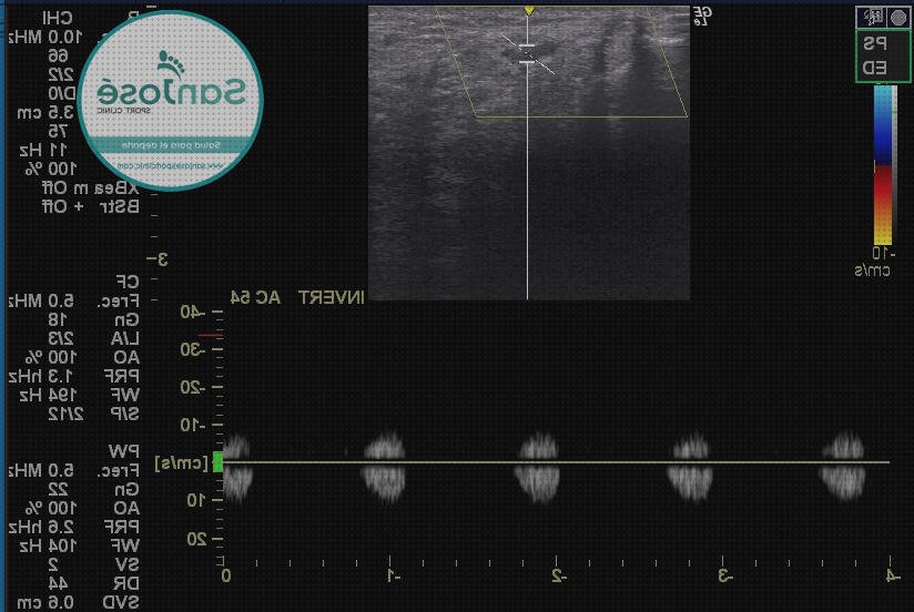 Los mejores 12 Ecos Doppler Pulsos En Pies