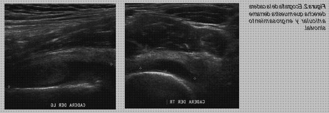 TOP 10 ecos doppler sinovitis