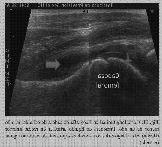 Las mejores marcas de doppler eco doppler sinovitis