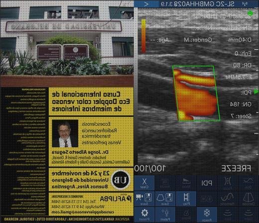 Opiniones de los 14 mejores Ecos Doppler Sistemas Venosos
