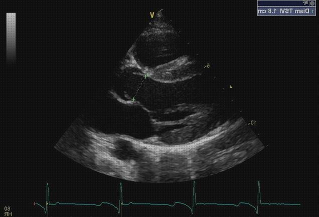 Las mejores ecos doppler eco doppler suprahepática