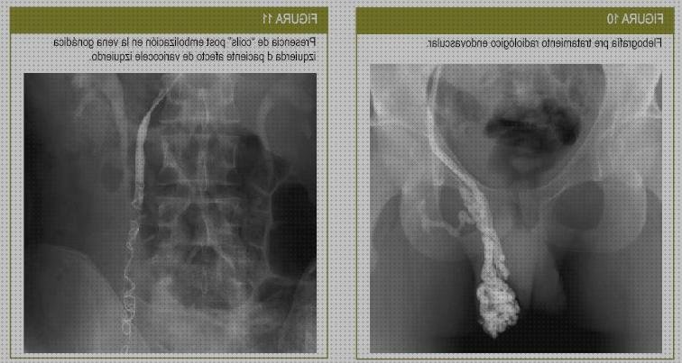 Los mejores 11 Ecos Doppler Testicular Niveles 1