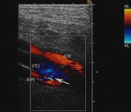 ¿Dónde poder comprar eco doppler triplex?