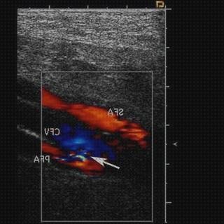 Las mejores eco doppler triplex