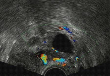 Las mejores eco doppler y ecografia ecografía doppler eco doppler vaginal