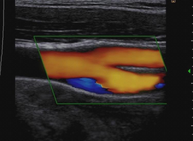 Las mejores marcas de ecos doppler eco doppler vascular precio