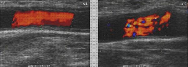 ¿Dónde poder comprar seram doppler eco doppler vasos de cuello seram?