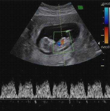 Las mejores ecos doppler eco doppler y ecografia