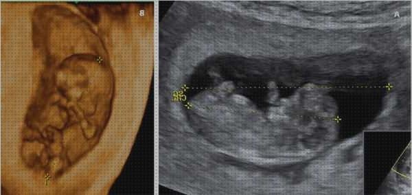 ¿Dónde poder comprar ecografía once semanas ecografía 10 semanas niña?