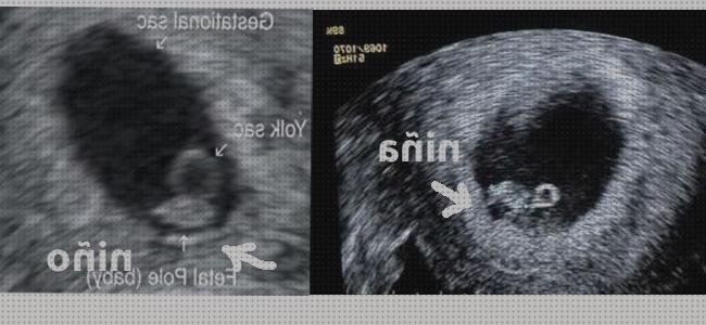 Las mejores marcas de ecografía once semanas ecografía 10 semanas niña