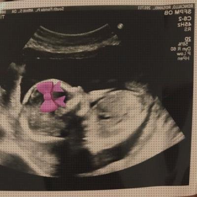 Review de ecografía 10 semanas niña