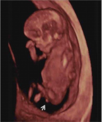 Review de ecografía 11 semanas 4d