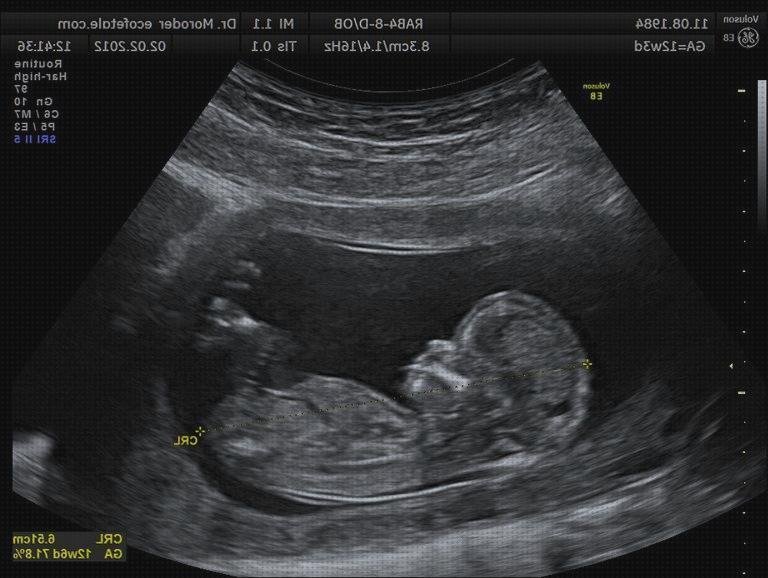 ¿Dónde poder comprar ecografía once semanas ecografía 12 semanas 11 semanas mas 2?