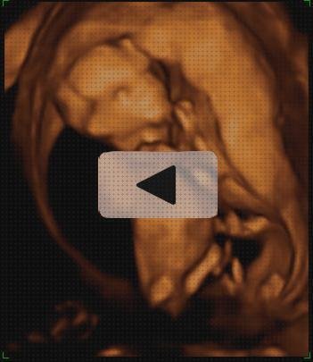 Las mejores Mas ecografía 12 semanas niño niña ecografía once semanas ecografía 12 semanas de embarazo 3d