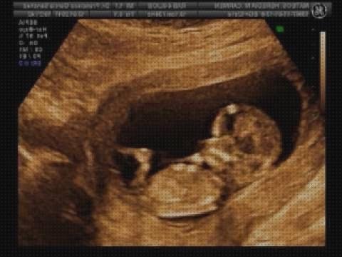 Opiniones de las 8 mejores Ecografías 12 Semanas De Embarazos 3d