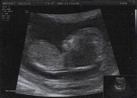 Review de ecografía 12 semanas niño