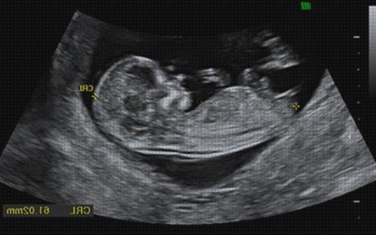 Las mejores marcas de Mas ecografía 12 semanas niño niña ecografía once semanas ecografía 12 semanas seguridad social