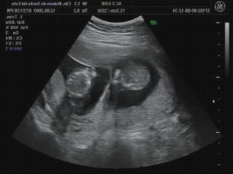 Las mejores marcas de ecografía dos meses ecografía 2 meses gemelos