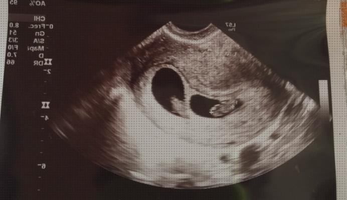 Las mejores ecografía dos meses ecografía 2 meses gemelos