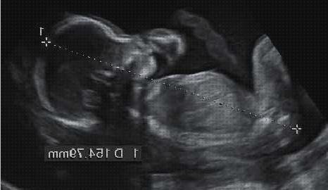 Las mejores marcas de ecografía once semanas ecografía 20 semanas niña