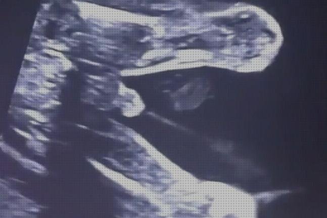 Las mejores ecografía once semanas ecografía 20 semanas niña