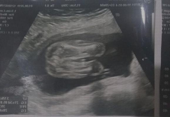 Las 13 Mejores Ecografías 20 Semanas Para Niñas