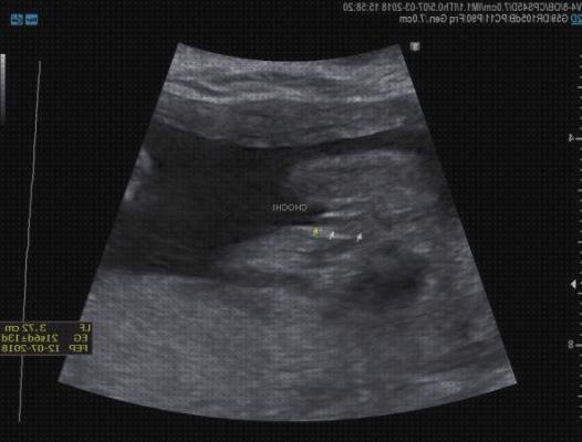 Opiniones de ecografía once semanas ecografía 21 semanas diabetes gestacional