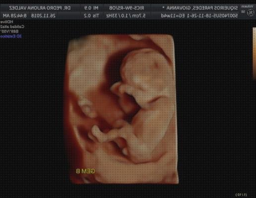 Review de ecografía 3 d niños