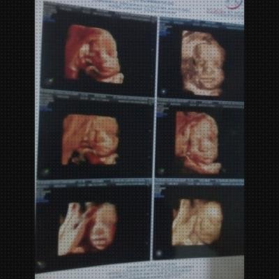 Las mejores ecografía once semanas ecografía 31 semanas