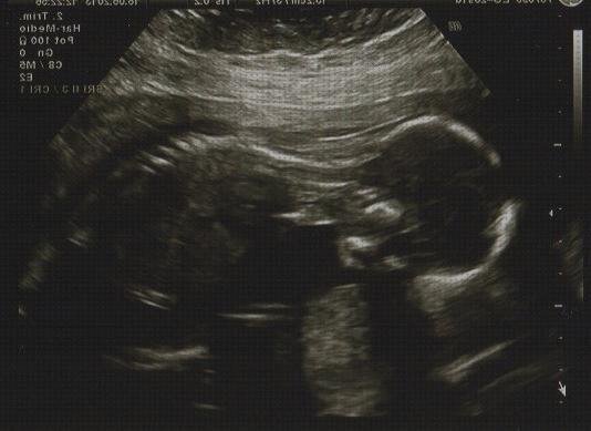 ¿Dónde poder comprar ecografía once semanas ecografía 33 semanas bebe vejiga llena?