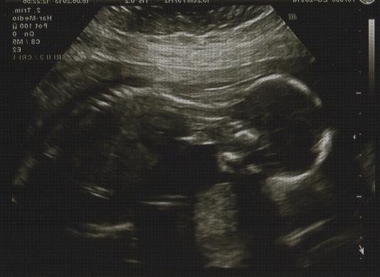 Las mejores ecografía once semanas ecografía 33 semanas bebe vejiga llena