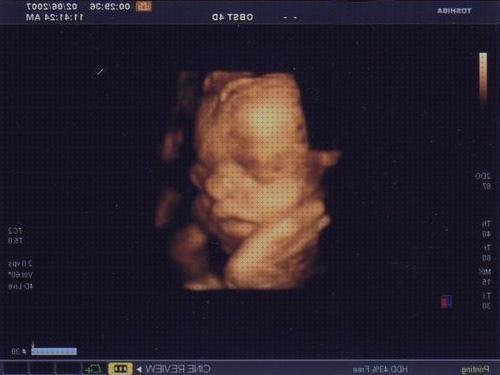 Review de ecografía 33 semanas bebe vejiga llena