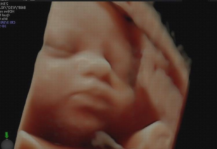 ¿Dónde poder comprar ecografía once semanas ecografía 4 semanas 5d?