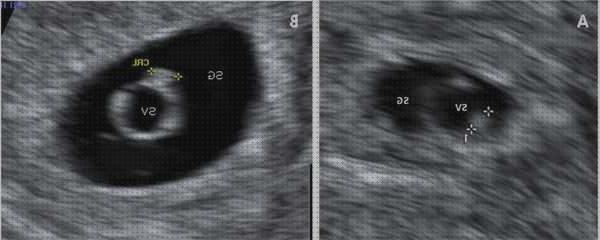Las mejores marcas de ecografía once semanas ecografía 5 semanas hospital