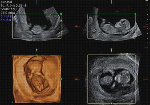 Opiniones de ecografía 4 semanas 5d ecografía once semanas ecografía 5d 21 semanas