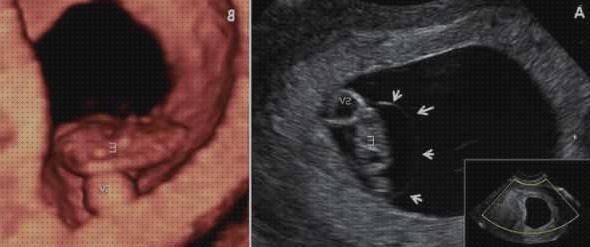 Las mejores 11 Ecografías 7 Semanas Y Medias