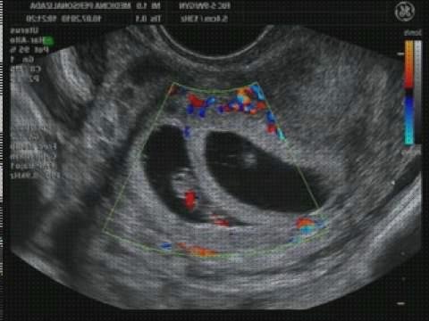 Review de ecografía 8 meses mellizos