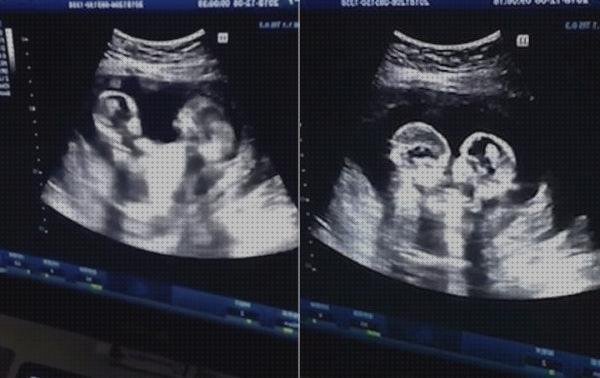 Las 11 Mejores Ecografías 8 Meses Mellizos